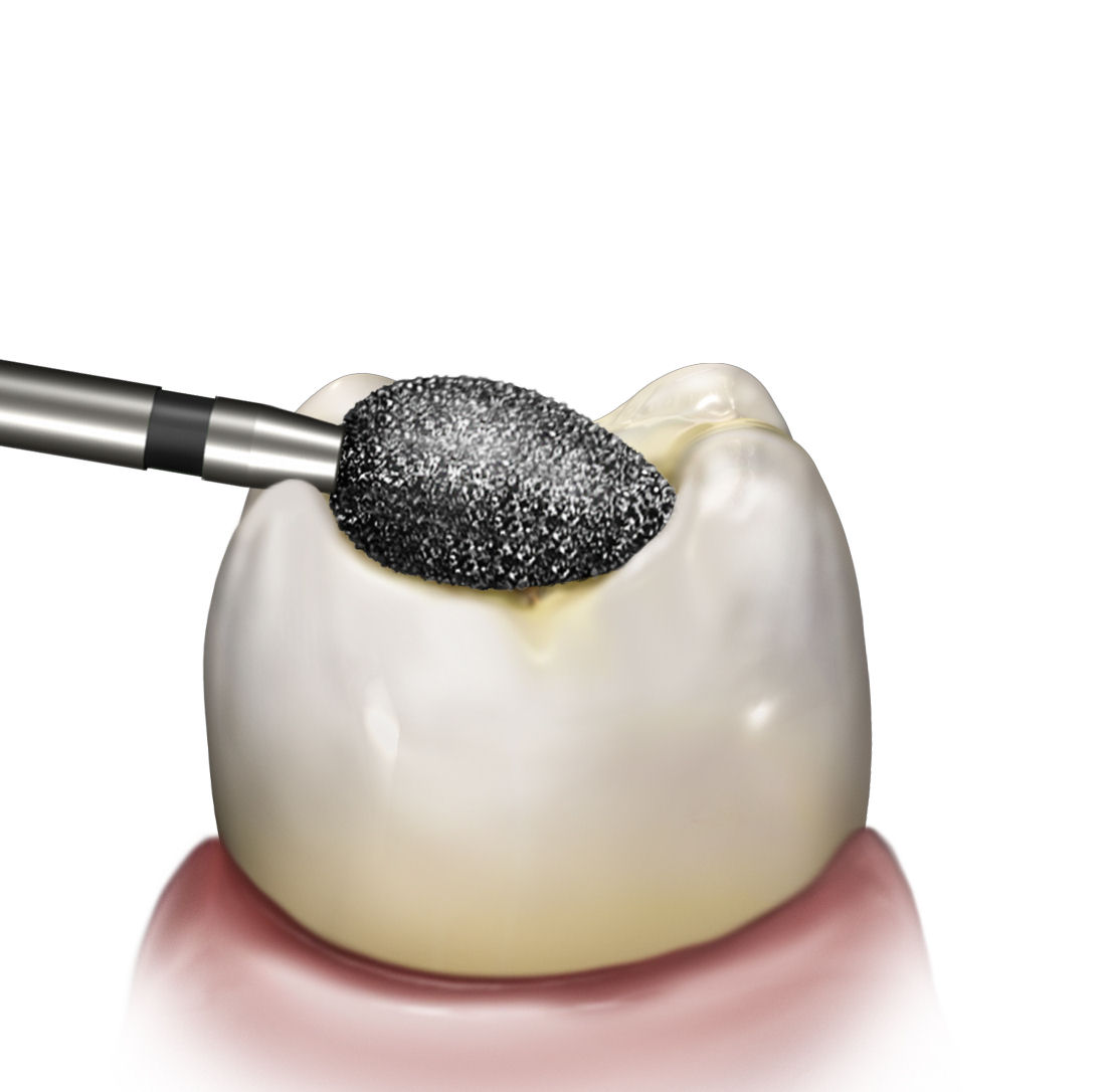 REVELATION DIAMOND 379-014 - Image 2