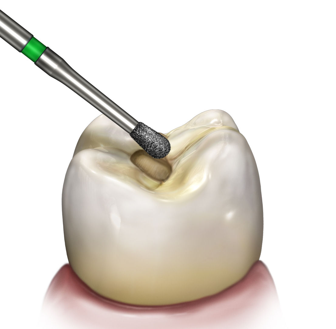 REVELATION DIAMOND 830-010 - Image 2